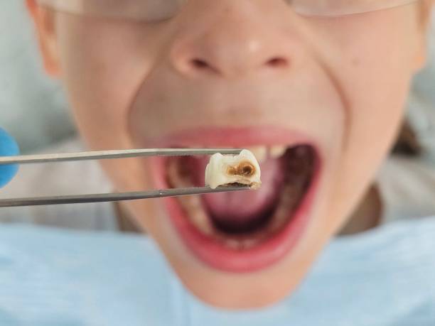 Best Emergency Tooth Extraction in Bayville, NY